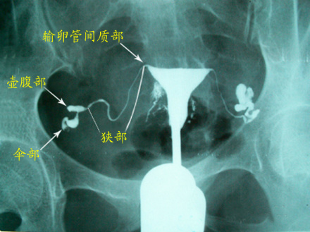 杭州试管助孕怀生个小孩的费用大概是多少